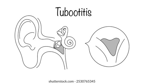 Inflamación de la membrana mucosa del tubo auditivo, provocada por procesos inflamatorios en la cavidad nasal y la nasofaringe. Ilustración médica con la ubicación de la enfermedad resaltada.