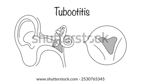 Inflammation of the mucous membrane of the auditory tube, provoked by inflammatory processes in the nasal cavity and nasopharynx. Medical illustration with the location of the disease highlighted.