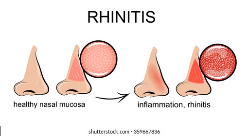 inflammation of the nasal mucosa