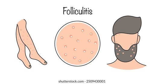 Inflamação de um ou mais folículos pilosos. A foliculite ocorre em qualquer lugar da pele pilosa. Manifestação de foliculite na pele das pernas e face. Ilustração vetorial.