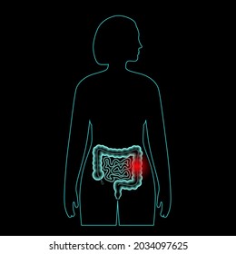 Inflammation And Pain In The Human Intestine. Inflammatory Bowel Disease, Ulcerative Colitis, Gastrointestinal Infections Or Colorectal Cancer. MEdical Exam Of Internal Organs 3D Vector Illustration