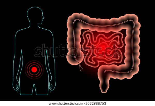 Inflammation and pain in the human\
intestine. Inflammatory bowel disease, ulcerative colitis,\
gastrointestinal infections or colorectal cancer. MEdical exam of\
internal organs 3D vector\
illustration
