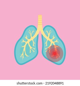 Inflammation and pain in the lungs of a person. Anatomy.