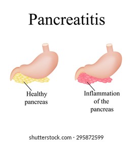 Inflammation of the pancreas. Pancreatitis. Vector illustration on isolated background.