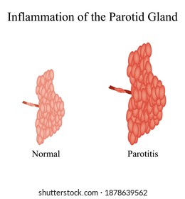 Inflammation of the parotid gland.The structure of the parotid salivary gland. Vector illustration on isolated background