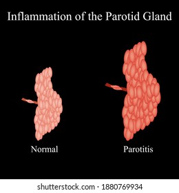 Inflammation of the parotid gland.The structure of the parotid salivary gland. Vector illustration on isolated background