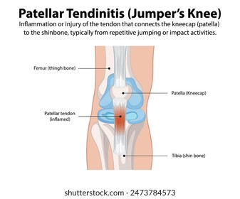 Inflammation of the patellar tendon from repetitive activities