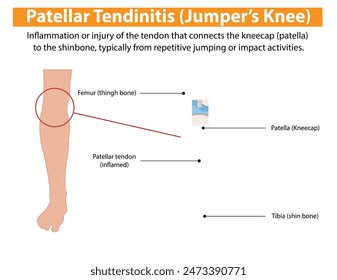 Inflammation of the patellar tendon from repetitive jumping