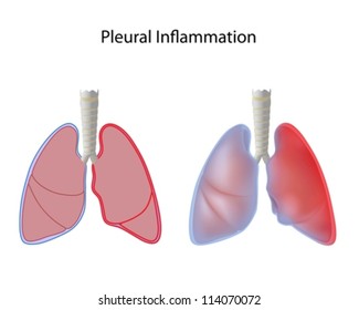 8,703 Lung inflammation Images, Stock Photos & Vectors | Shutterstock