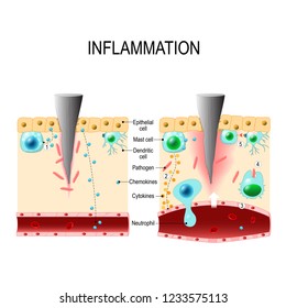 Inflammation is a process by which white blood cells protect of the body from infection with bacteria and viruses. Phagocytes are attack any patogens. Immune system. for educational and biological use