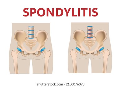 Inflammation of the sacroiliac joint of the lower back, arthritis 3d medical tissue illustration