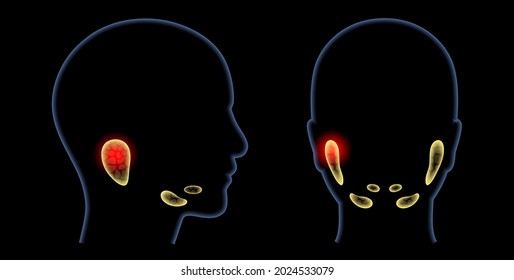 Inflammation Of A Salivary Glands In Human Mouth. Parotid, Submandibular, And Sublingual Gland. Produce Of Saliva Through A System Of Ducts. Xerostomia Oral Disease. Medical 3d Vector Illustration.