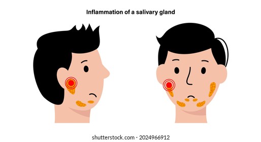 Inflammation Of A Salivary Glands In Human Mouth. Parotid, Submandibular, And Sublingual Gland. Produce Of Saliva Through A System Of Ducts. Xerostomia Oral Disease. Medical Flat Vector Illustration.