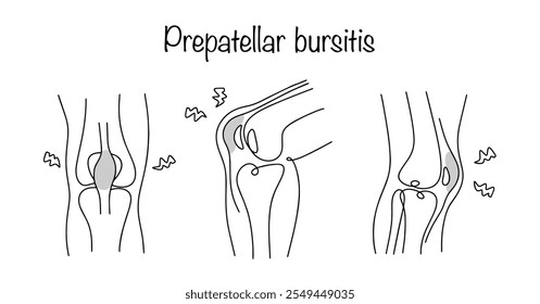 Inflammation of the synovial bursa, in which an increased amount of pathological fluid is formed in it. Drawn bursitis of the knee from different angles and rotations. Simple line illustration.