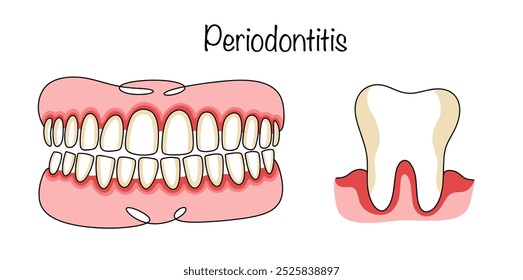 Entzündung der Gewebe um den Zahn, die zum vollständigen oder teilweisen Verlust der Zähne führen kann. Farbvektorgrafik, die Zahnfleischentzündungen zeigt. Medizinischer Vektor für verschiedene Verwendungen.