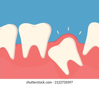 Inflammation of the tooth under the gum causes pain in the mouth. The concept of dental care. Vector cartoon illustration.