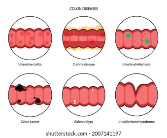 Enfermedad intestinal inflamatoria, cáncer de colon y pólipos. Inflamación del sistema digestivo. Infecciones intestinales y Síndrome intestinal Irritable. Colitis ulcerosa y cráneo ilustración vectorial de la enfermedad