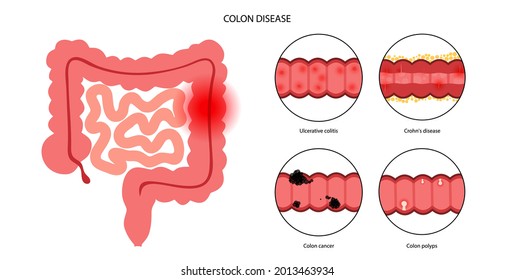 Enfermedad intestinal inflamatoria, cáncer de colon y pólipos. Inflamación del sistema digestivo. Examen médico del cuerpo humano. Colitis ulcerosa y enfermedad de los crones. Dolor en la ilustración intestinal plana vectorial