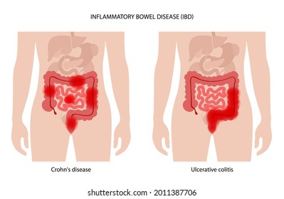 Inflammatory bowel disease concept. Crohns disease and ulcerative colitis. Inflammation of the digestive tract abdominal pain, colon problem in the human body. Medical poster flat vector illustration.