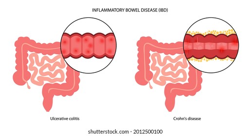 Inflammatory bowel disease concept. Crohns disease and ulcerative colitis. Inflammation of the digestive tract abdominal pain, colon problem in the human body. Medical poster flat vector illustration.