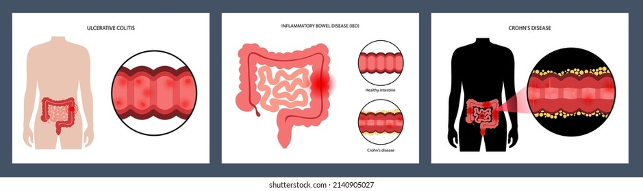 Inflammatory Bowel Disease Concept. Crohns Disease And Ulcerative Colitis. Inflammation Of The Digestive Tract Abdominal Pain, Colon Problem In The Human Body. Medical Poster Flat Vector Illustration