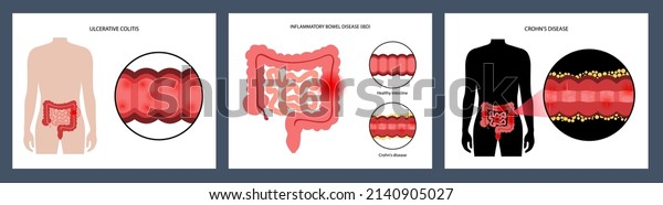 Inflammatory bowel disease concept. Crohns\
disease and ulcerative colitis. Inflammation of the digestive tract\
abdominal pain, colon problem in the human body. Medical poster\
flat vector\
illustration
