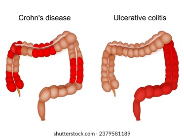 Entzündliche Darmerkrankung. Unterschied und Vergleich des Dickdarms bei Patienten mit Morbus Crohn und Colitis ulcerosa. Gastrointestinale Entzündung. Vektorgrafik