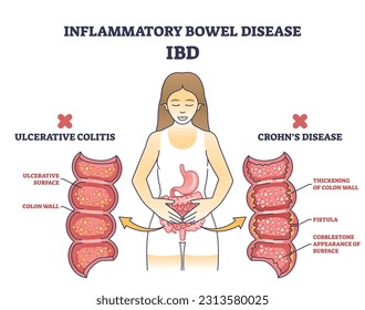 Inflammatory bowel disease or IBD with Crohns condition and ulcerative colitis outline diagram. Labeled educational scheme with chronic inflammation of gastrointestinal tract vector illustration.