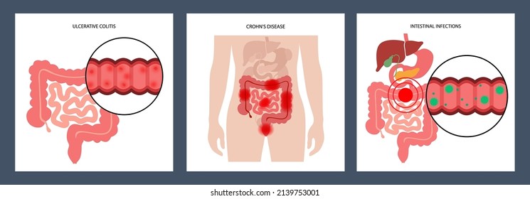 Inflammatory bowel disease and Viral Infections. Crohns disease and ulcerative colitis. Inflammation of digestive tract abdominal pain, colon problem in the human body. Medical poster flat vector.