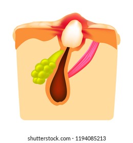 Inflammatory comedones. acne. The structure of the skin. Infographics. Vector illustration on isolated .