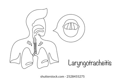 Lesão inflamatória das membranas mucosas da laringe e da traqueia, que leva a inchaço, espasmo do trato respiratório superior e distúrbios da voz. Uma pessoa com laringotraqueíte. Vetor.