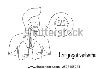 Inflammatory damage to the mucous membranes of the larynx and trachea, which leads to swelling, spasm of the upper respiratory tract and voice disorders. A person with laryngotracheitis. Vector.