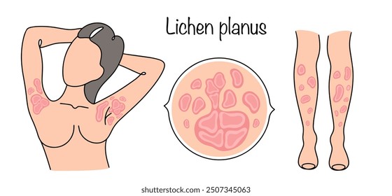 Inflammatory dermatosis with damage to the skin and mucous membranes. A woman with a skin disease on her body. Color vector illustration for different uses. Medical vector.