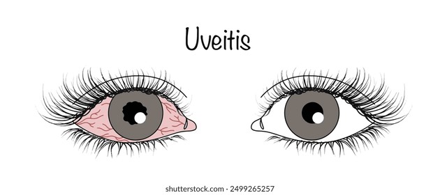 Inflammatory disease of the choroid of the eye. An eye with uveitis and a healthy human eye. Inflammation inside the eye. Simple color vector illustration.