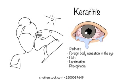 Inflammatory disease of the cornea of the eye. The woman closes her eyes from the light. An eye with symptoms of keratitis nearby. Medical illustration for different uses.