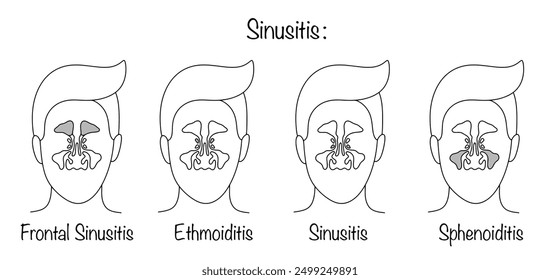 Inflammatory disease of the mucous membranes of the maxillary, ethmoid, frontal and sphenoid sinuses. Types of sinusitis depending on the location of inflammation. Medical vector.