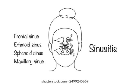 Inflammatory disease of the mucous membranes of the paranasal sinuses. The face of a girl with healthy and diseased sinuses. Vector illustration.