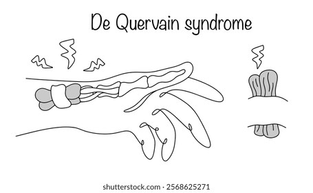 An inflammatory disease that affects the tendons and surrounding tissues in the wrist area, closer to the thumb. The disease causes pain and limited movement. Isolated vector on white background.