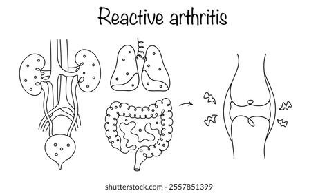 An inflammatory joint disease that develops as the body's response to infections in the genitourinary system, intestines or respiratory tract. A simple diagram of the disease reactive arthritis.