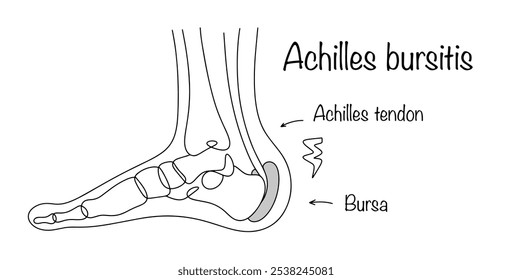 Lesão inflamatória da cápsula articular localizada na área do tendão calcâneo. Ilustração em preto e branco de uma perna com bursite de Aquiles. Vetor isolado no fundo branco.