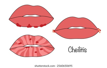 Inflammatory process in the area of the mucous membrane, skin and red border of the lips. Drawn variants of the manifestation of cheilitis. Color vector illustration for use in the medical field.