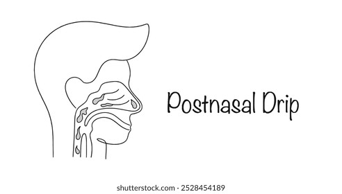 Un proceso inflamatorio en la nasofaringe, en el cual la secreción mucosa fluye hacia las secciones subyacentes del tracto respiratorio. El moco fluye por la garganta de una persona. Ilustración vectorial.