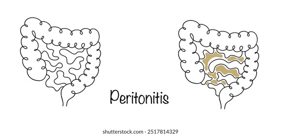 Un proceso inflamatorio en el peritoneo, que causa intoxicación severa, afectando los órganos y sistemas internos. Intestinos sanos e intestinos con peritonitis. Vector aislado.