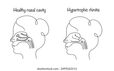 An inflammatory process that is accompanied by the growth of mucous membrane in the area of the nasal turbinates. Healthy sinuses and nose with hypertrophic rhinitis. Vector.