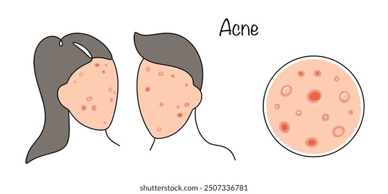 Enfermedad inflamatoria de la piel asociada con aumento de la producción de sebo y glándulas sebáceas agrandadas y obstruidas. Hombre y mujer con problema de acné en la cara. Ilustración vectorial.