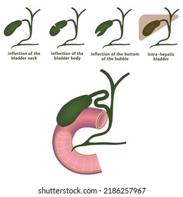 Inflection Gallbladder Diagram Varieties Organ Pathology Stock Vector ...