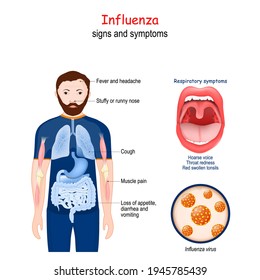 Influenza Flu Signs Symptoms Infectious Disease Stock Vector (Royalty ...