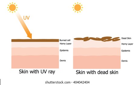 Infographic about cause of dead skin by the UV ray