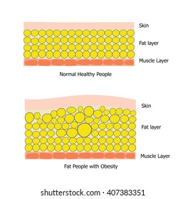 Infographic about fat people and healthy people which the obesity people  has big fat cell and got unhealthy  