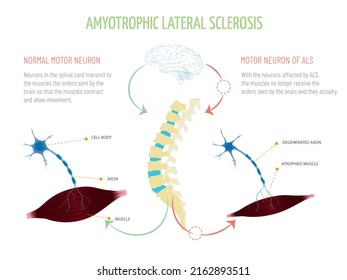 

Infographic about the functioning of the orders from the brain to the muscles with and without amyotrophic lateral sclerosis.